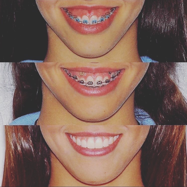 Tratamento com Invisalign — antes e depois